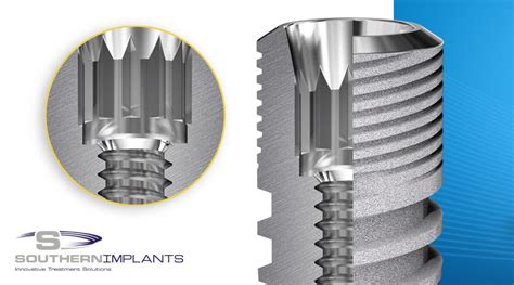  Vitrocerámica, Un Material de Alta Resistencia para Implantes Dentales Innovadores!